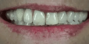 Snap-On Veneers von NovaBright schaffen ein schnelles, natürlich aussehendes Lächeln für obere und untere Zähne