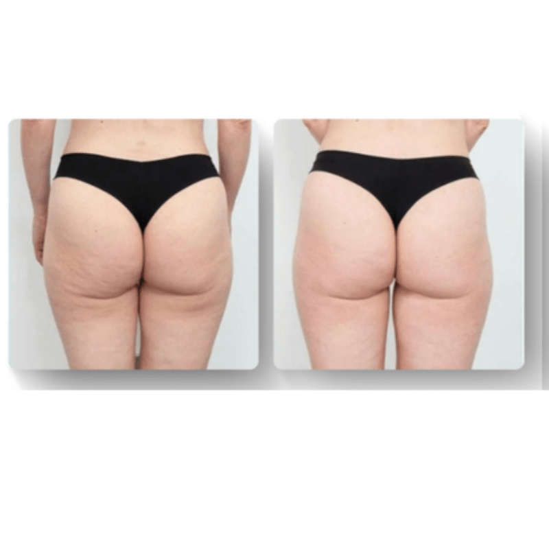 LuxeSilhouette Anti-Cellulite-Massager | Verbessere deine Hautpflegeroutine mit einem hochwertigen verjüngenden Massager