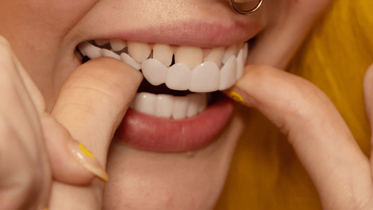 Snap-On Veneers von NovaBright schaffen ein schnelles, natürlich aussehendes Lächeln für obere und untere Zähne