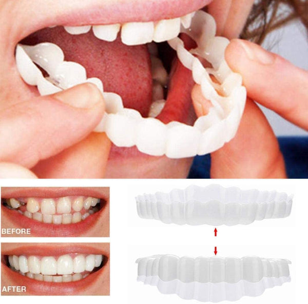 Auf Smile Veneers (Ober- und Unterkiefer inbegriffen)