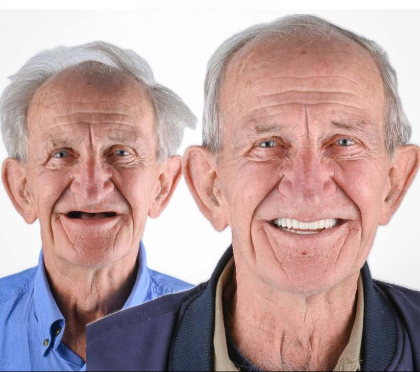 DentalKit - Natürliches Aussehen und Gefühl ohne Zahnarzt!