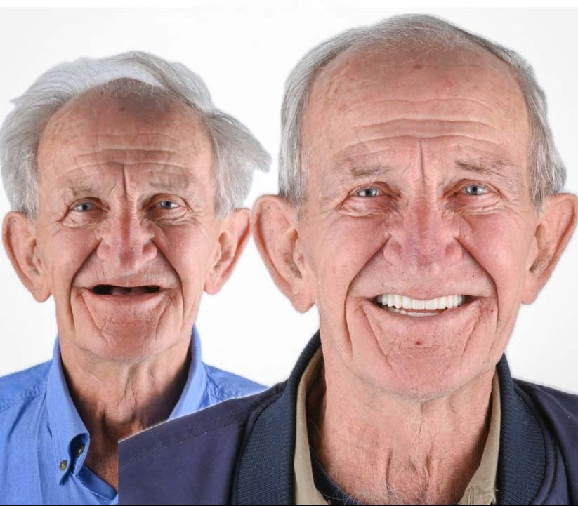 DentalKit - Natürlicher Look und Gefühl ohne den Zahnarzt!