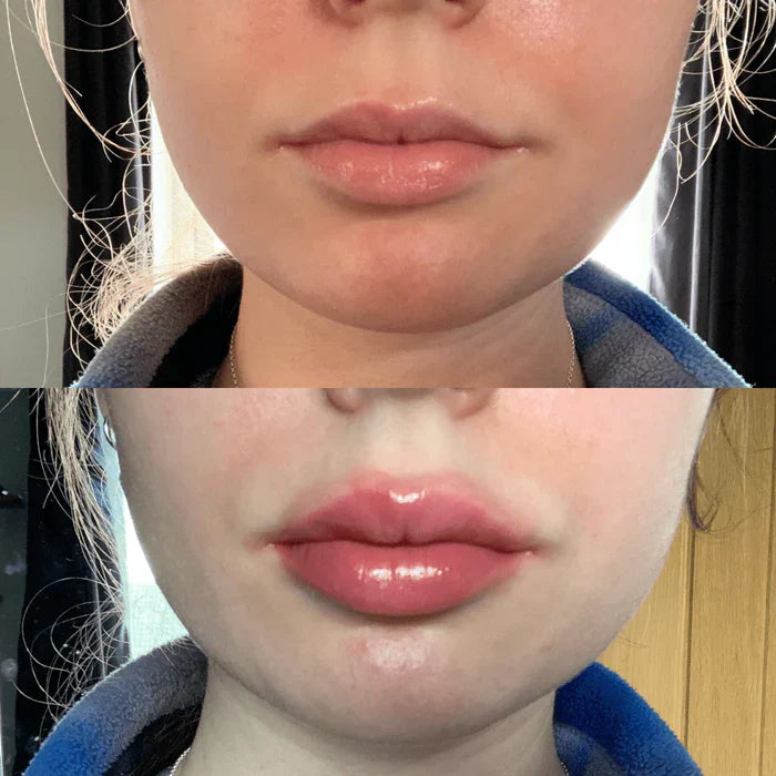 Sofortiges Lippenvolumen-Serum