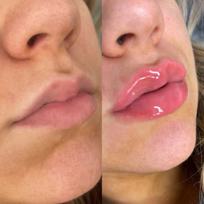 Sofortiges Lippenvolumen-Serum
