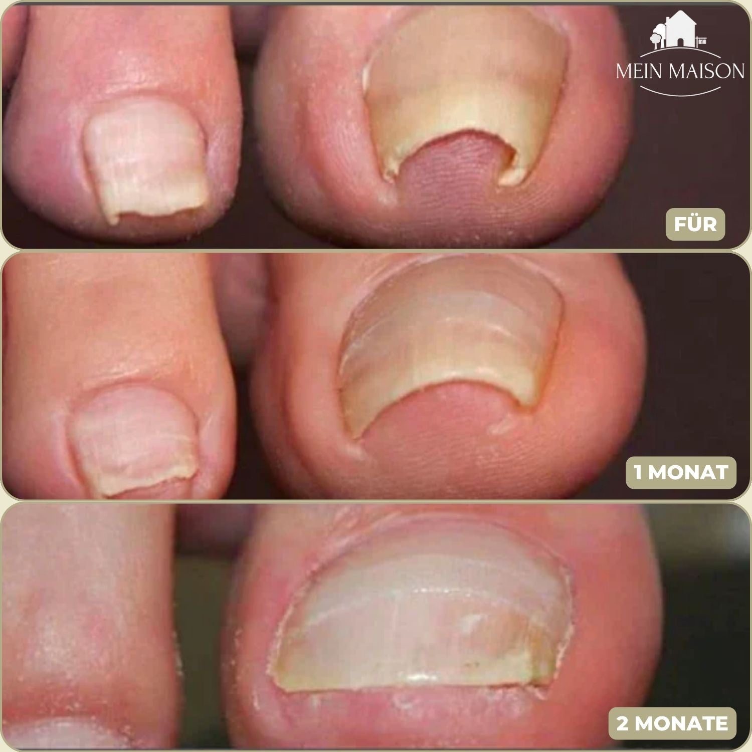 10+10 Gratis FixaNail Direkte Nagelreparatur