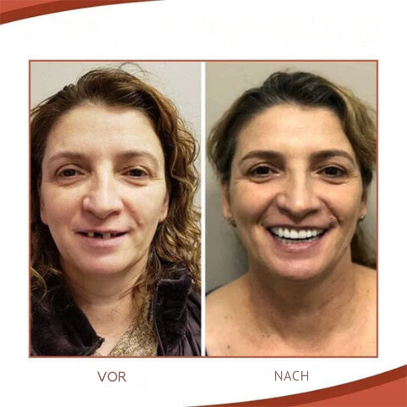 Biokompatibles Silikonprothesen-Set für schmerzfreie Passform und natürliches Lächeln