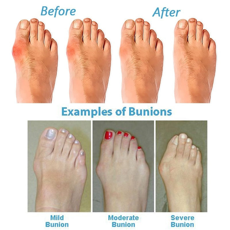 Sandalen für Hallux Valgus - OrthoSole Sommer 2025 Edition