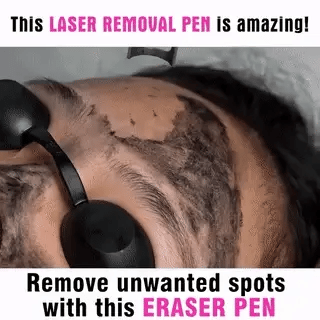 LumiDerm Home Laser Pen zur Entfernung von Tätowierungen, Muttermalen und Sommersprossen