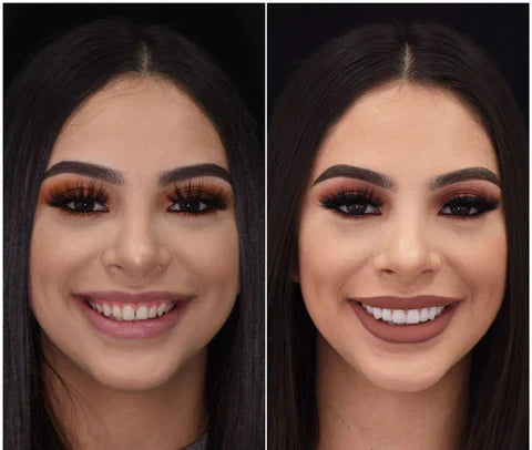Snap-On Veneers von NovaBright schaffen ein schnelles, natürlich aussehendes Lächeln für obere und untere Zähne
