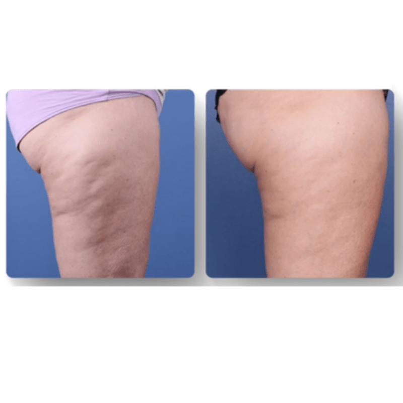 LuxeSilhouette Anti-Cellulite-Massager | Verbessere deine Hautpflegeroutine mit einem hochwertigen verjüngenden Massager