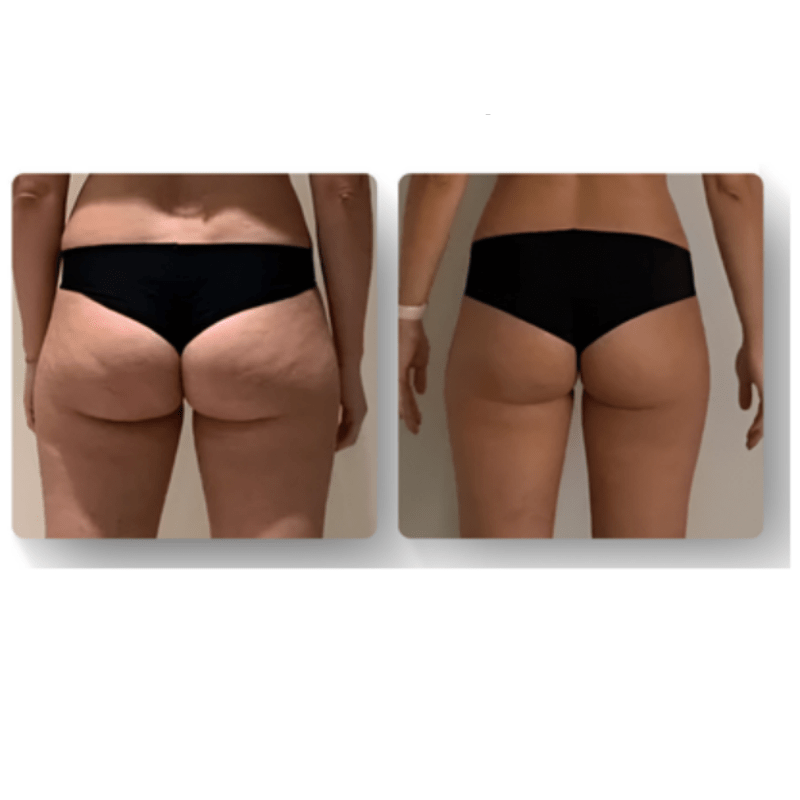 LuxeSilhouette Anti-Cellulite-Massager | Verbessere deine Hautpflegeroutine mit einem hochwertigen verjüngenden Massager