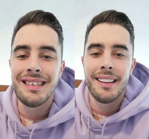 Auf Smile Veneers (Ober- und Unterkiefer inbegriffen)