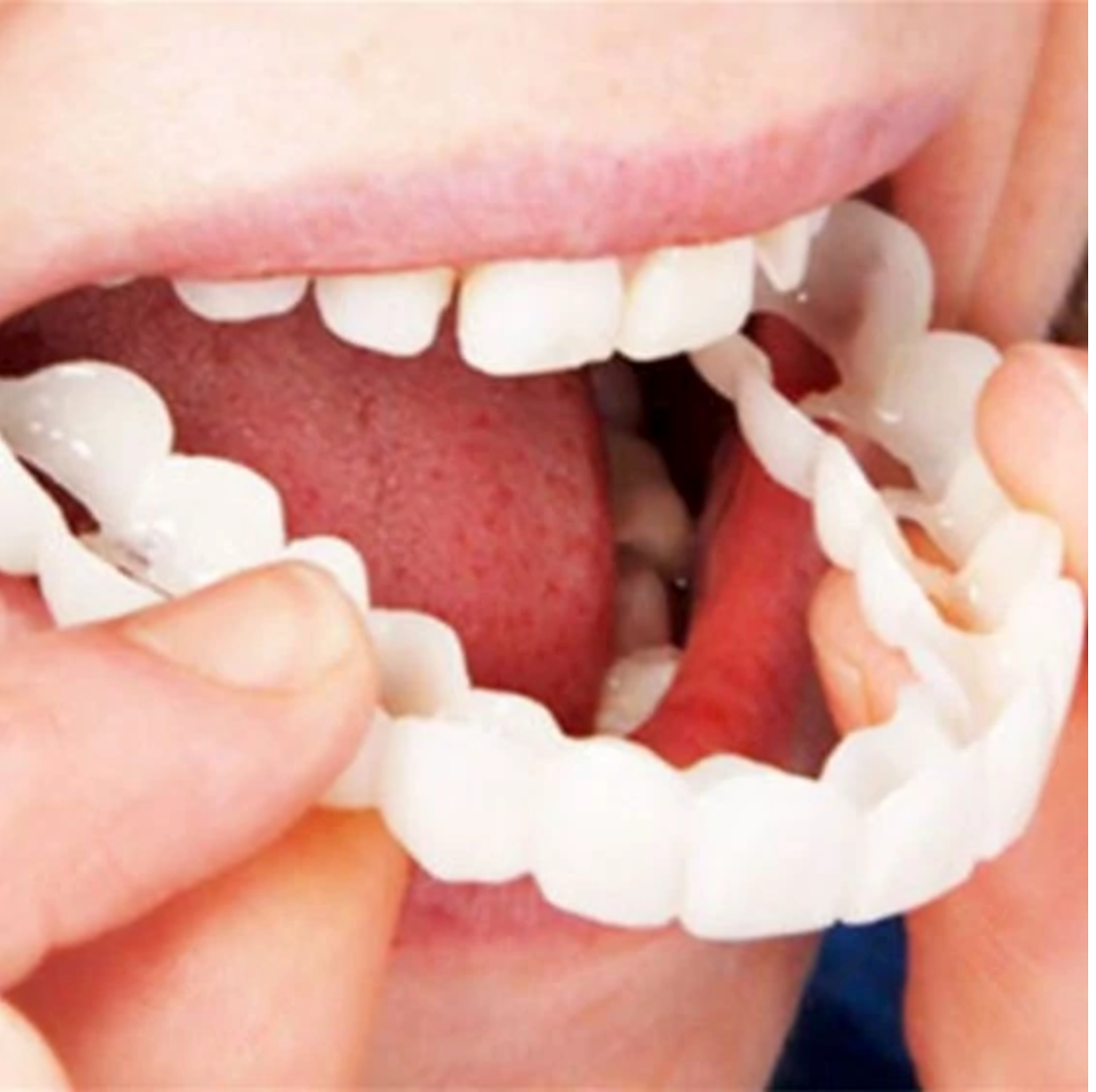 HappySmile Facetset | Wiederverwendbare Ober- und Unterfacetten für ein strahlendes Lächeln