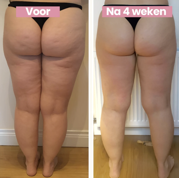 SmoothLift | Anti-Cellulite & Hautstraffungsbehandlung
