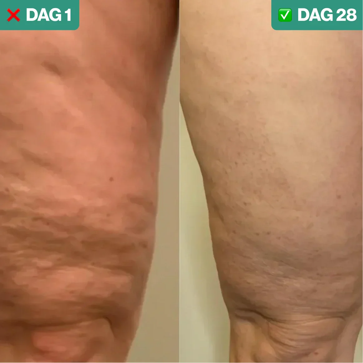 SmoothLift | Anti-Cellulite & Hautstraffungsbehandlung