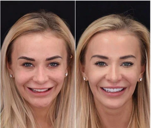 Snap-On Veneers von NovaBright schaffen ein schnelles, natürlich aussehendes Lächeln für obere und untere Zähne
