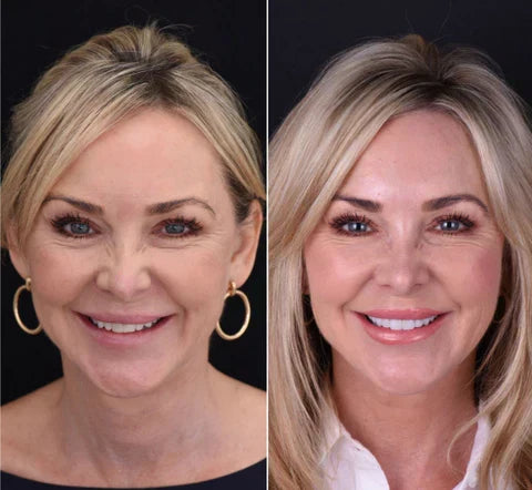 Snap-On Veneers von NovaBright schaffen ein schnelles, natürlich aussehendes Lächeln für obere und untere Zähne