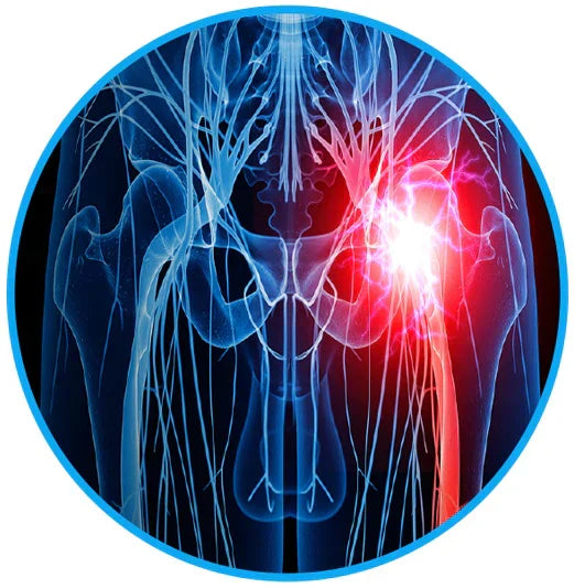 Sciatica Schmerz Linderungs Gürtel - beseitigen Sie Ihre Ischias- & Rückenschmerzen