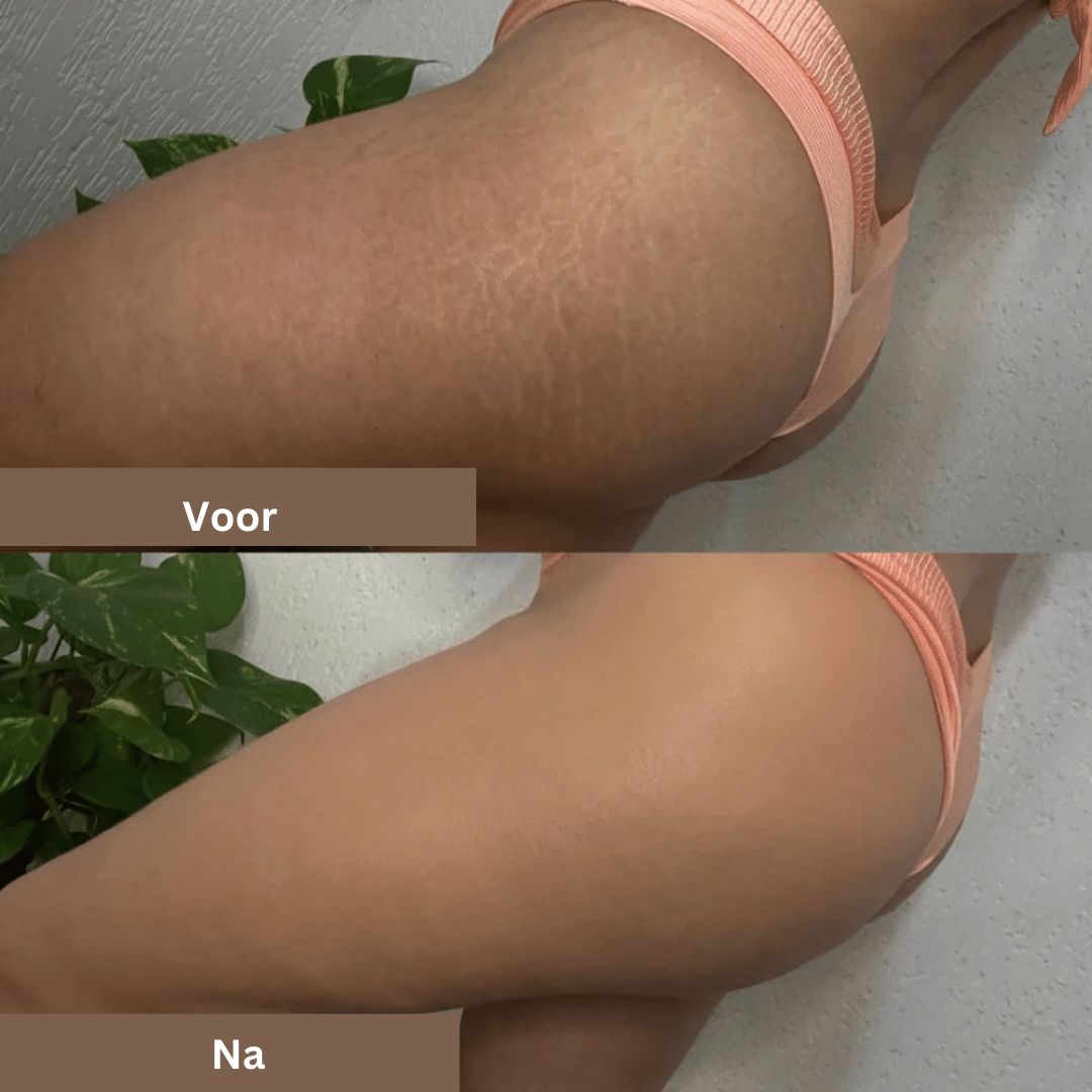 SmoothTone Hautpflege | Zum Abdecken von Narben, Adern, Akne und Sonnenflecken