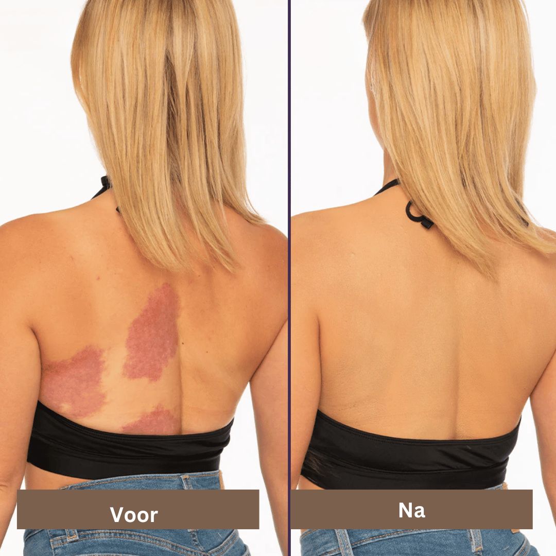 SmoothTone Hautpflege | Zum Abdecken von Narben, Adern, Akne und Sonnenflecken